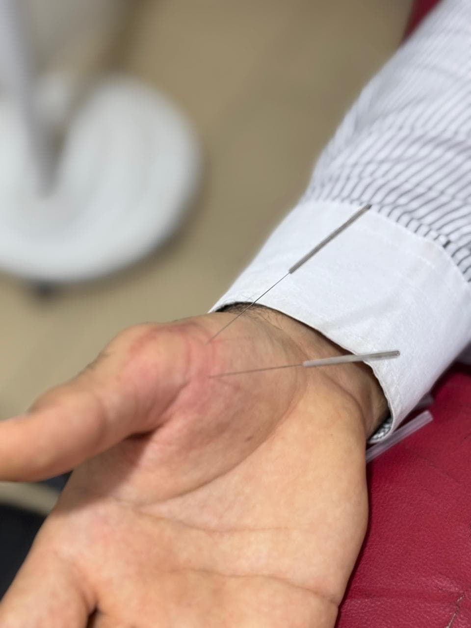 العلاج بالإبر الصينية