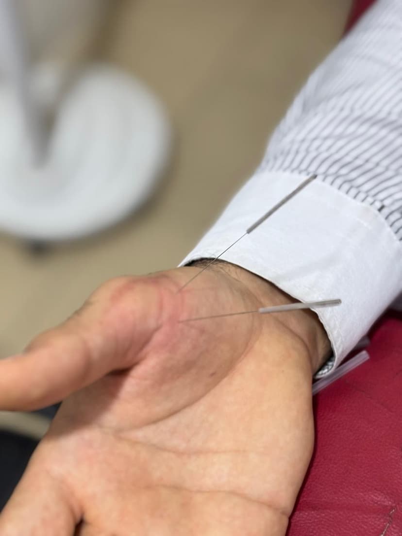 Acupuncture